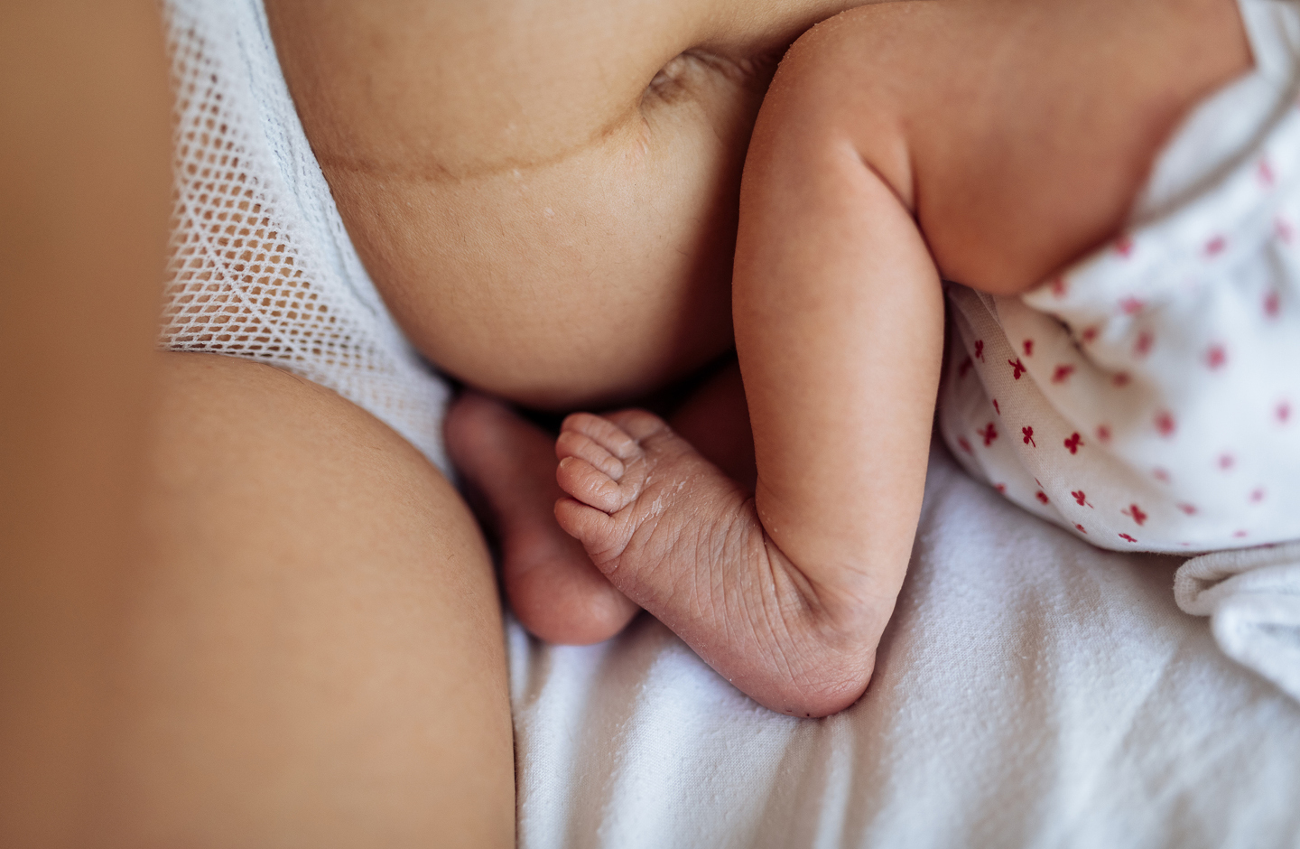 Bildausschnitt Bauch mit deutlichen Spuren der Geburt, Babybeine